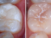 Trám bít hố rãnh (Sealant) giúp phòng ngừa sâu răng