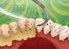 [Bạn cần biết] "Cạo vôi răng" hiểu đúng như thế nào?