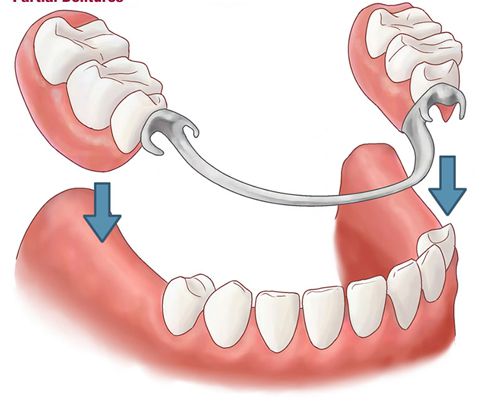 Phục hình tháo lắp toàn hàm hàm trên, bán hàm hàm dưới